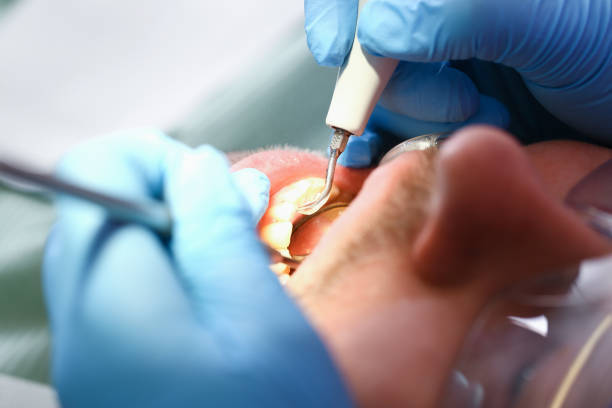 Best Emergency Dentist for Knocked-Out Tooth in Carroll, IA
