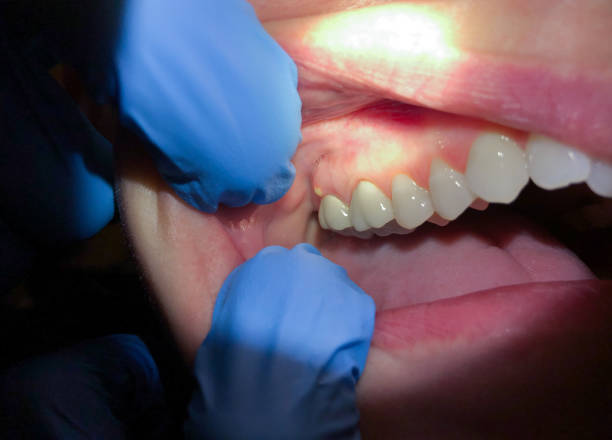 Best Emergency Dental Services for Seniors in Carroll, IA