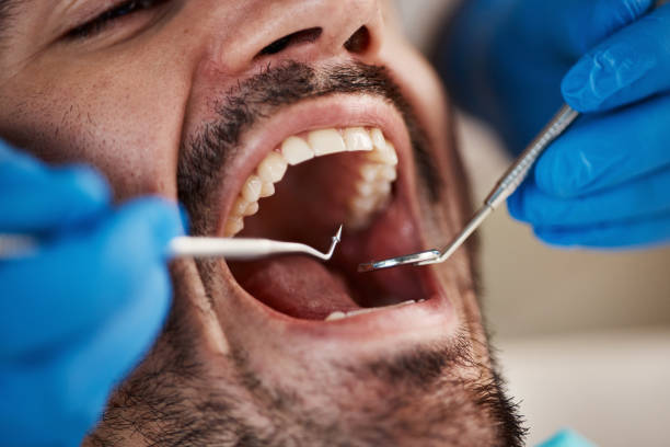 Best Emergency Dentist for Lost Fillings or Crowns in Carroll, IA